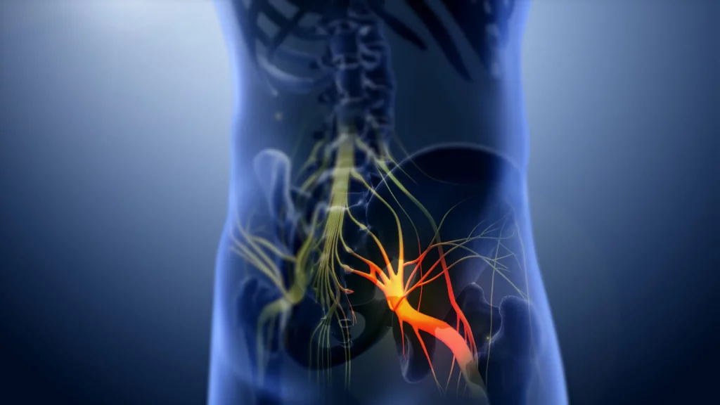 Ayurvedic treatment for Sciatica