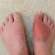 Natural treatment for gout